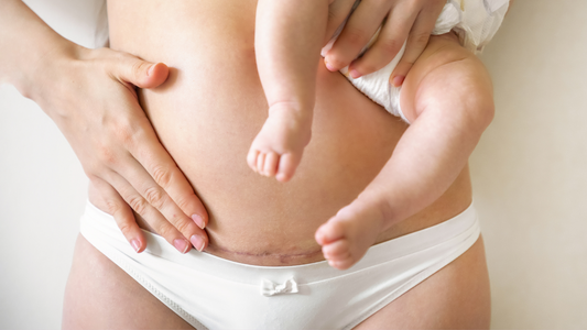 7 cosas que deberías saber sobre la cesárea